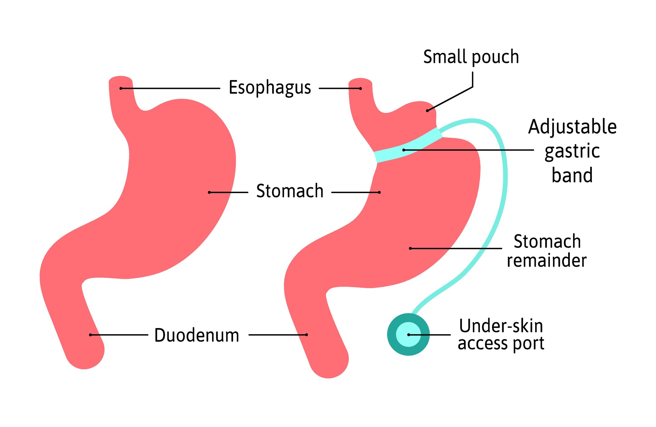 An image explaining the Gastric Band surgery.