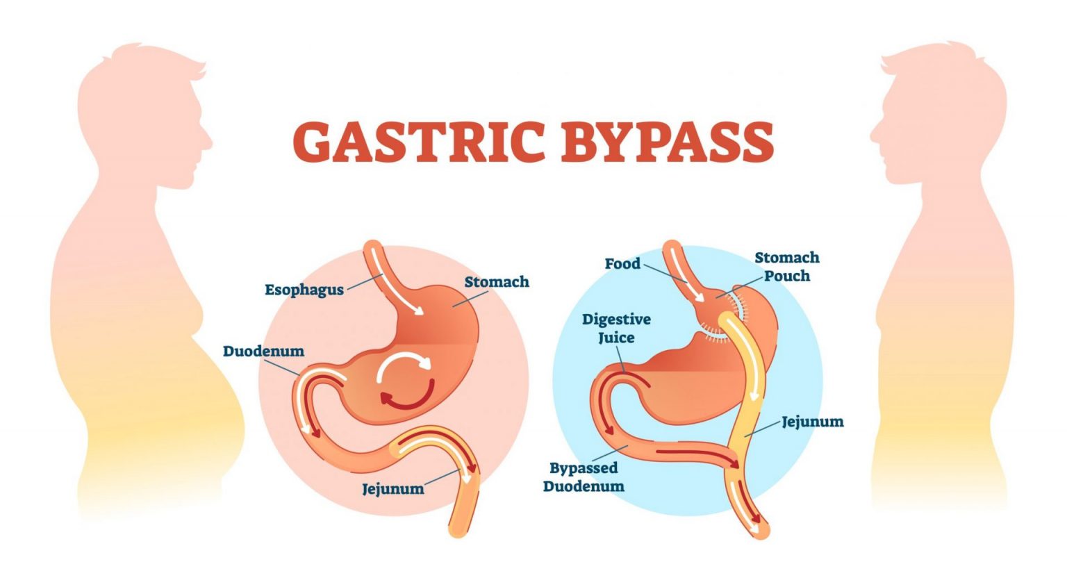 Gastric Bypass Surgery Perth Bariatric Surgeon Stomach Bypass 