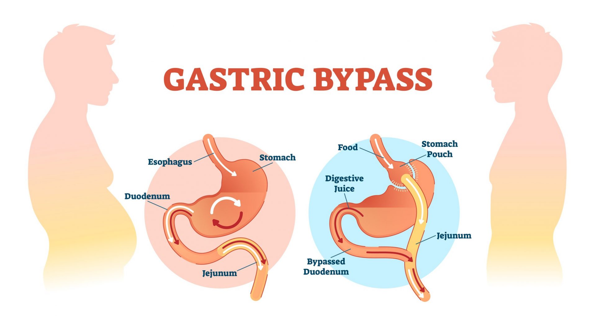 An image explaining the Gastric bypass surgery.